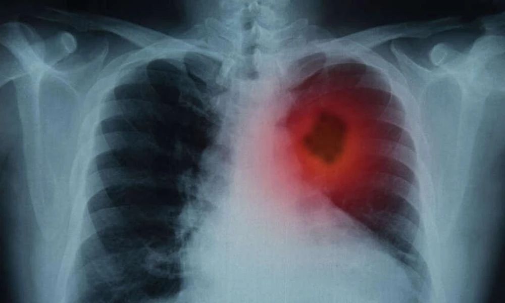 Καρκίνος πνεύμονα: Οι εξελίξεις στη θεραπεία – Ποια είναι η εξέταση που εντοπίζει εγκαίρως τη νόσο
